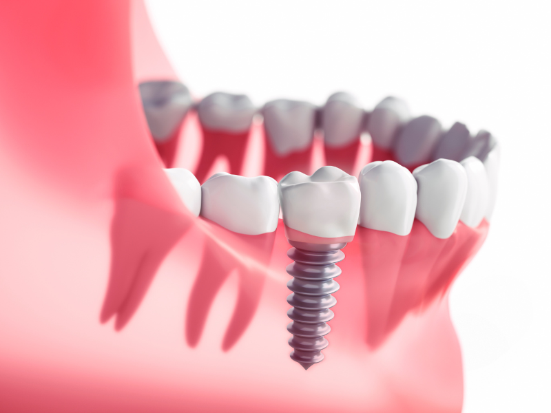 Advanced Dental Implants