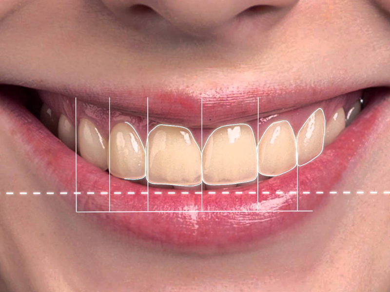 Digital Smile Designing