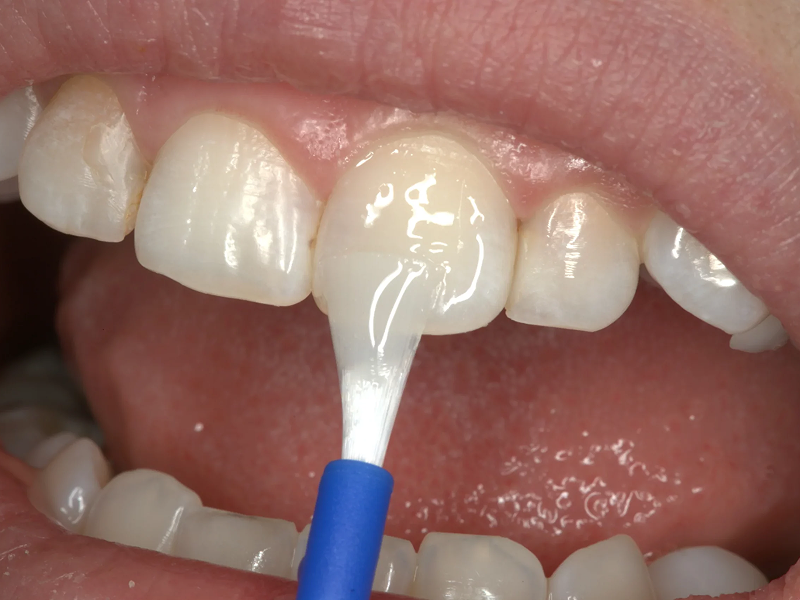 Fluoride Varnish