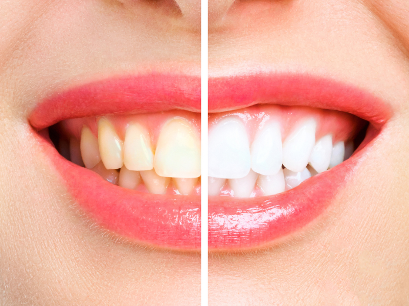  Professional Teeth Whitening